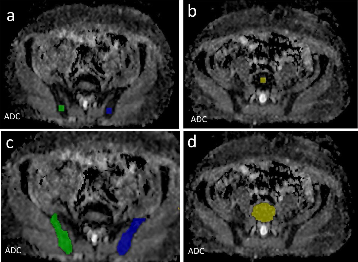 birpublications.org/doi/epub/10.12…. Whole body diffusion-weighted MRI in relapsed #myeloma: apparent diffusion coefficient measurements of focal lesions are repeatable and reproducible but there is more variation in diffuse disease <a href="/ImperialImmuno/">Imperial Department of Immunology & Inflammation</a> <a href="/ImperialNHS/">Imperial NHS 💙</a> <a href="/ImperialBRC/">NIHR Imperial BRC</a>