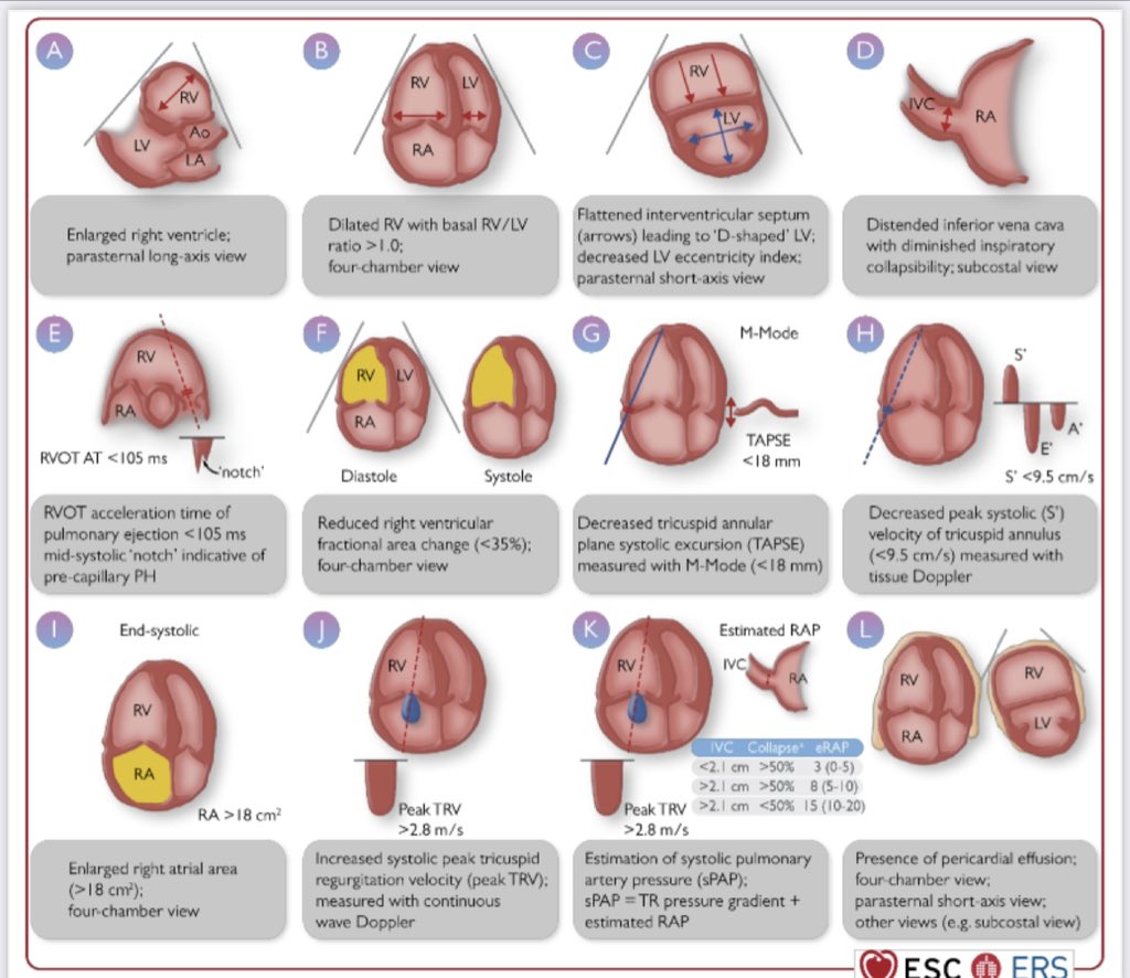 #PHguidelines #esc2022 Finally! #RVfunction / RV-PA coupling is included is in the ESC guidelines! TAPSE/sPAP ❤️‍🔥 @escardio #EchoRight #echofirst @CharlesFauvel @CardioOnline #tapseforever @EACVIPresident