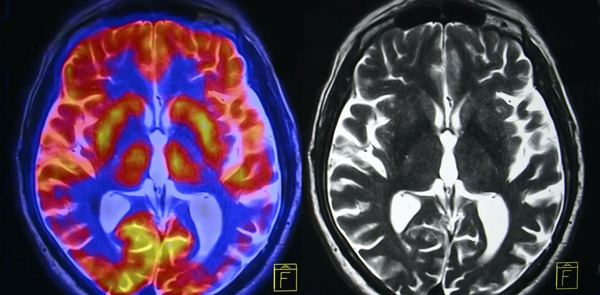 How chronic #stress changes the brain – and what you can do to reverse the damage buff.ly/2QMQxx6