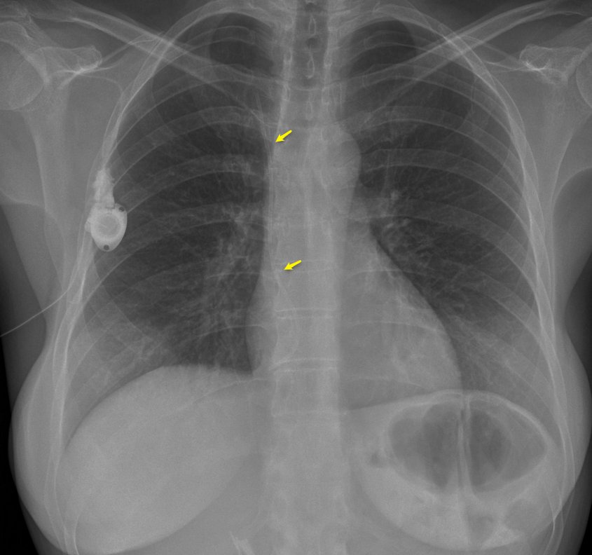 VirTauli's tweet photo. A 51-y.o. patient with broken catheter into the VCS/AD from a venous port. https://t.co/uvU3HGEBjB