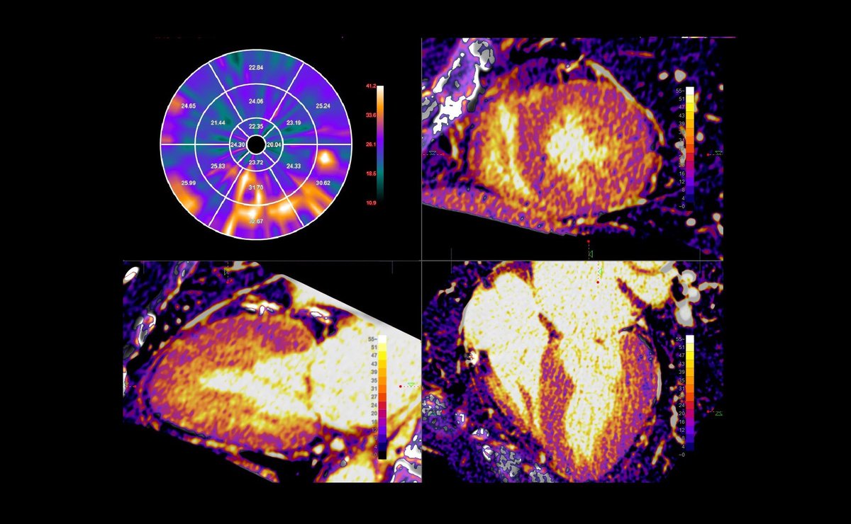 ziosoft's tweet photo. Enabling a Cardiac Imaging Bio-Marker for the management of patience care.  Ziosoft presents ECV-CT for TAVR Analysis at European Society of Cardiology in Barcelona.  Visit us at ESC booth # 1230. 
 #esc2022 #esccongress #cardiology #cardiacimaging https://t.co/v4H4EZHALJ