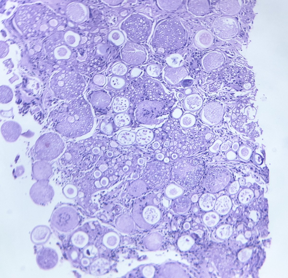 pathologicrain's tweet photo. 54 yr male with a thigh mass. Suspected to be a soft tissue sarcoma.  What are are these #PathBugs ?#PathArt #Pathology #Pathtweet #PathTwitter @GerardButler @Vik_deshpandeMD @smlungpathguy @nandinipath @Meghna0630 @VijayPatho @adi_agnihotri https://t.co/T7KKhGB78g