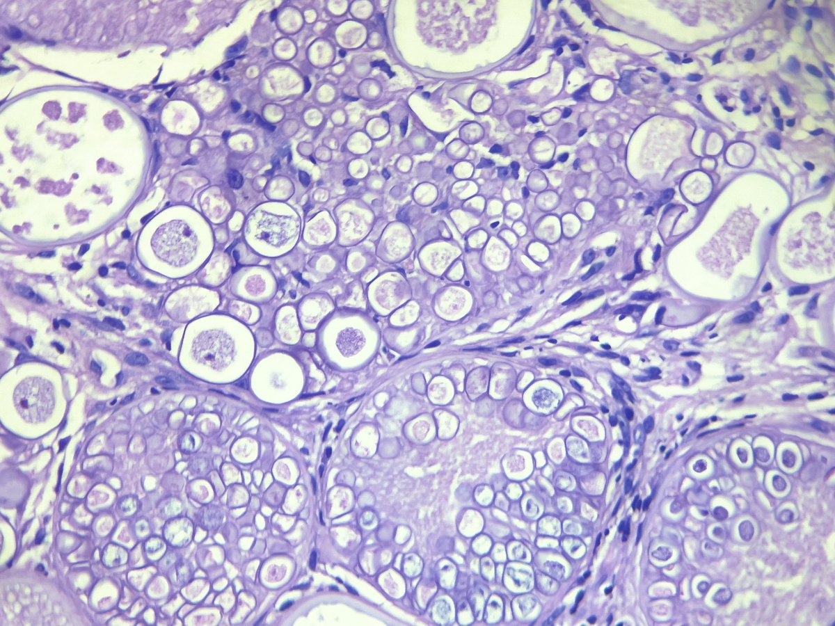 pathologicrain's tweet photo. 54 yr male with a thigh mass. Suspected to be a soft tissue sarcoma.  What are are these #PathBugs ?#PathArt #Pathology #Pathtweet #PathTwitter @GerardButler @Vik_deshpandeMD @smlungpathguy @nandinipath @Meghna0630 @VijayPatho @adi_agnihotri https://t.co/T7KKhGB78g