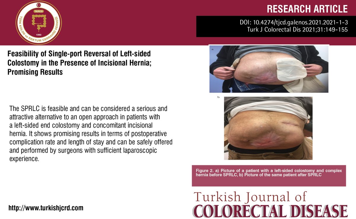 turkdiscolrect's tweet photo. Feasibility of Single-port Reversal of Left-sided Colostomy in the Presence of Incisional Hernia; Promising Results
You can see the free full text of the research by Yu-Ting van Loon et al.
Link : https://t.co/54znpZS3HF
#Singleport #hernia #ventral #surgery #incisional https://t.co/MGMJDwvUop