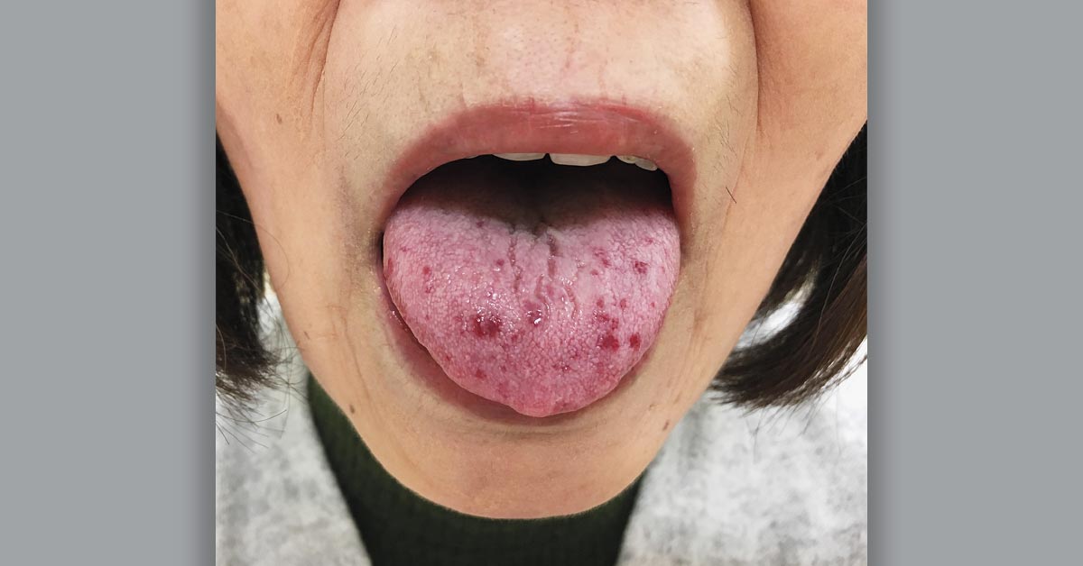 NEJM's tweet photo. A 61-year-old woman with primary biliary cholangitis and Raynaud’s phenomenon was referred to the rheumatology clinic. Tongue telangiectasias, puffy fingers, and nailfold capillary hemorrhage were present. https://t.co/h6IkCGGWXE https://t.co/I3hmQC2a4n