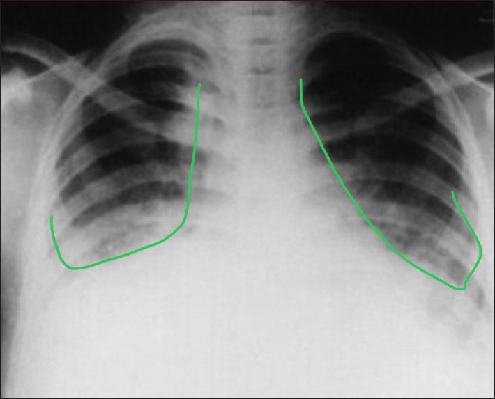 Qiiib's tweet photo. Cara nak tengok dia senang je. Pelajar perubatan pun boleh detect.

Belah kiri: normal xray dada
Belah kanan: xray yang ada air

Gambar dari google.

Belah kanan, nampak tak bahagian bawah peparu melengkung ke atas berbanding kiri yang melengkung ke bawah?

Itulah culprit dia https://t.co/T7k1LtcA7c