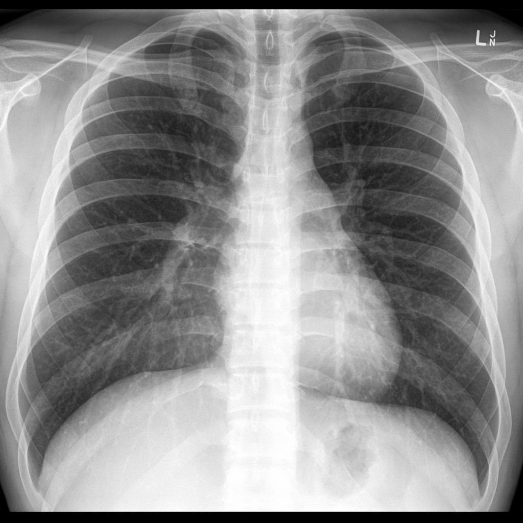 Qiiib's tweet photo. Cara nak tengok dia senang je. Pelajar perubatan pun boleh detect.

Belah kiri: normal xray dada
Belah kanan: xray yang ada air

Gambar dari google.

Belah kanan, nampak tak bahagian bawah peparu melengkung ke atas berbanding kiri yang melengkung ke bawah?

Itulah culprit dia https://t.co/T7k1LtcA7c