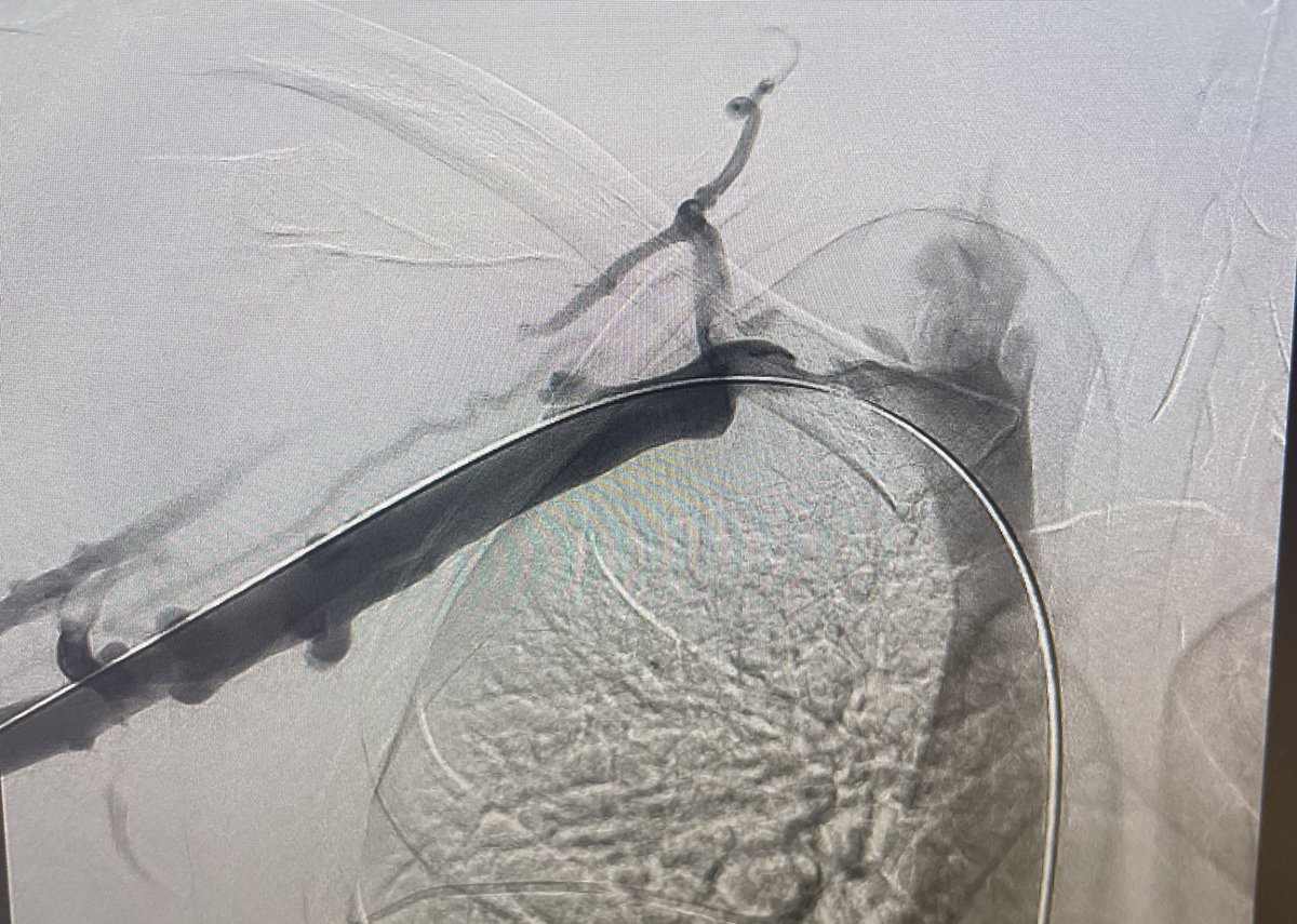 FionaMaloneMD's tweet photo. thrombectomy and venoplasty iso Paget Schrotter syndrome with very satisfying result. #IR #thrombectomy #declot https://t.co/7sq0su0RnW