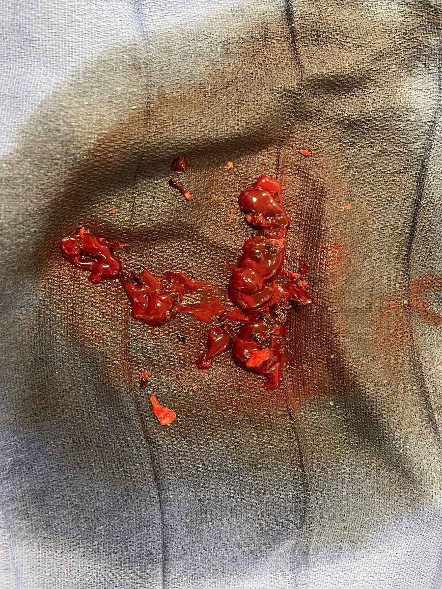 FionaMaloneMD's tweet photo. thrombectomy and venoplasty iso Paget Schrotter syndrome with very satisfying result. #IR #thrombectomy #declot https://t.co/7sq0su0RnW