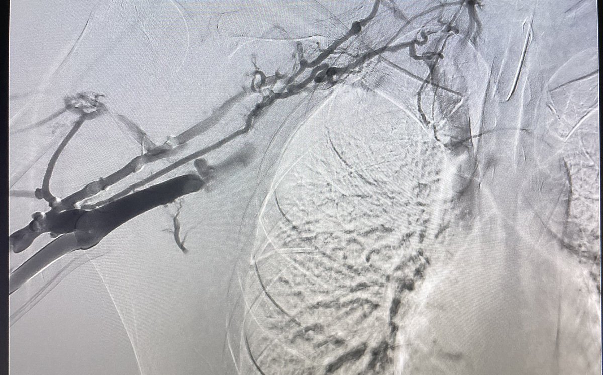 FionaMaloneMD's tweet photo. thrombectomy and venoplasty iso Paget Schrotter syndrome with very satisfying result. #IR #thrombectomy #declot https://t.co/7sq0su0RnW