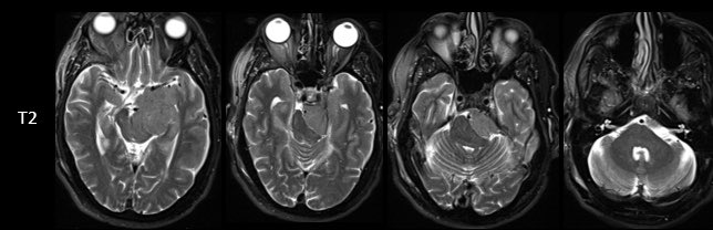 Jacques Morcos MD FRCS FAANS tweet media