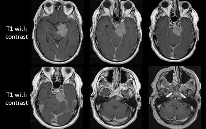 Jacques Morcos MD FRCS FAANS tweet media