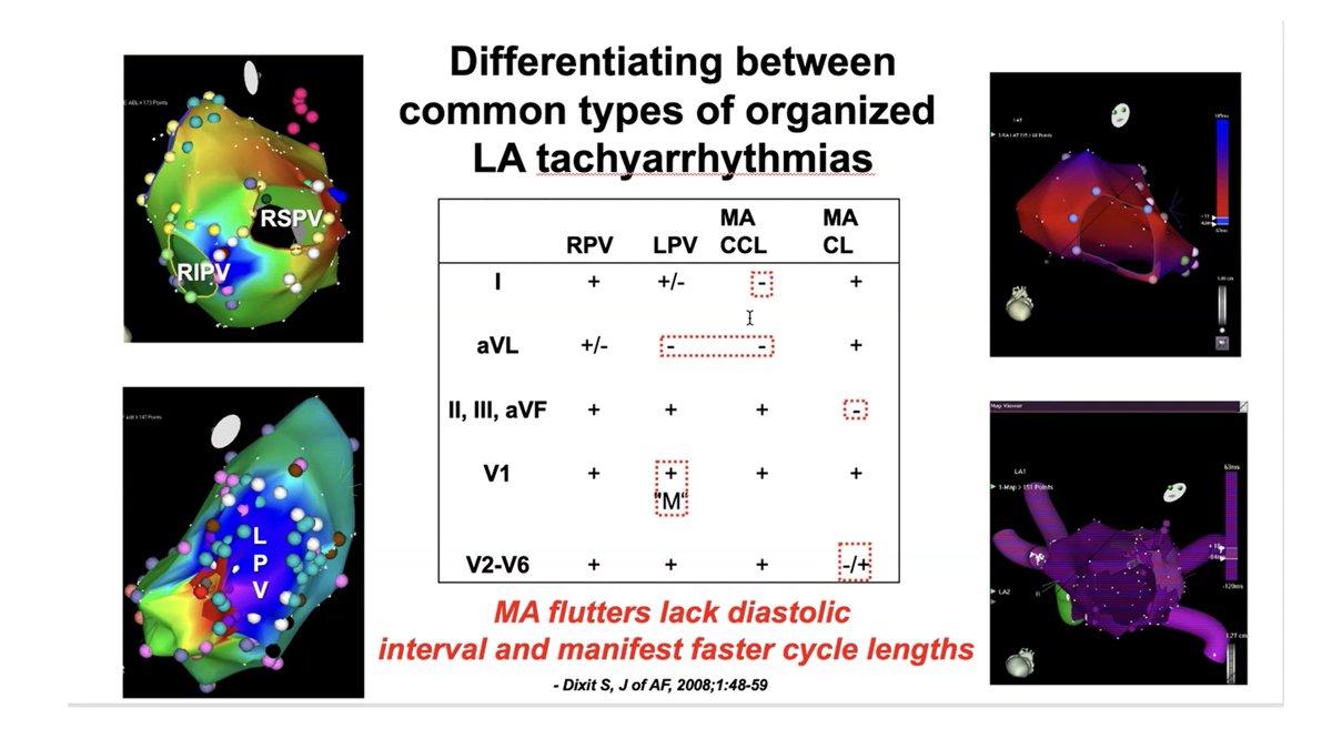 Penn Electrophysiology Fellowship (@pennepfellows) on Twitter photo ECG localization of LA flutters. Dr. Dixit breaks it down this morning during teaching.
#EPeeps #CardioTwitter #ECG
<a href="/PennCardiology/">Penn Cardiology</a> ECG localization of LA flutters. Dr. Dixit breaks it down this morning during teaching.
#EPeeps #CardioTwitter #ECG
<a href="/PennCardiology/">Penn Cardiology</a>