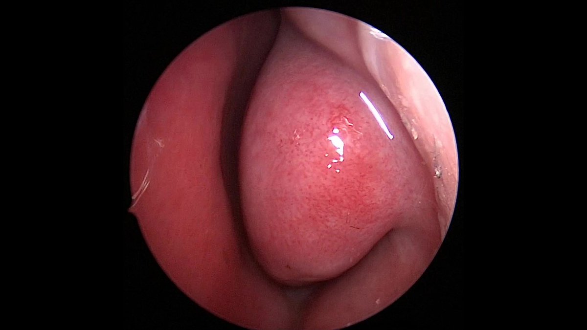 JohnCraigNose's tweet photo. Let's highlight another case to be discussed at the 3rd annual #HFSNS on Fri 10/7. Ever had a septoplasty or inf turb submucosal reduction fail? Frustrating? Have you tried bony inf turb reductions? Want to learn? Register to join us!
@henryfordent https://t.co/P7bpjjhZmR https://t.co/Wlv0NDSSWl