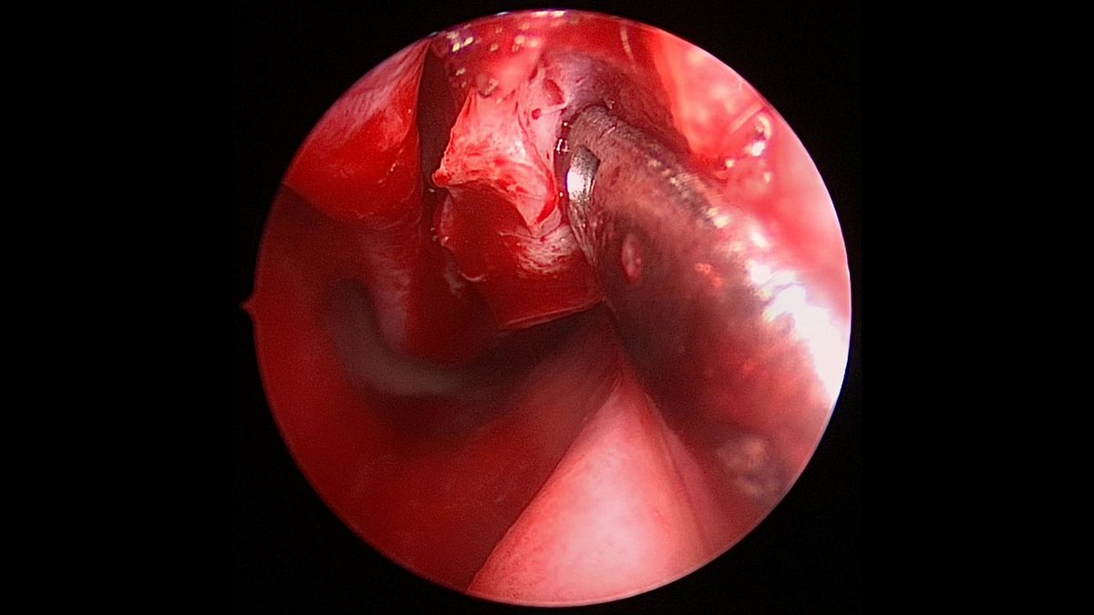 JohnCraigNose's tweet photo. Let's highlight another case to be discussed at the 3rd annual #HFSNS on Fri 10/7. Ever had a septoplasty or inf turb submucosal reduction fail? Frustrating? Have you tried bony inf turb reductions? Want to learn? Register to join us!
@henryfordent https://t.co/P7bpjjhZmR https://t.co/Wlv0NDSSWl