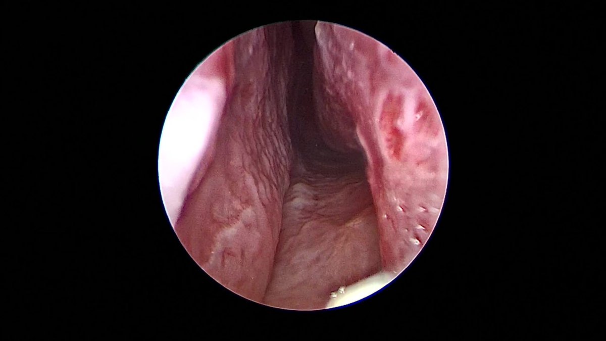 JohnCraigNose's tweet photo. Let's highlight another case to be discussed at the 3rd annual #HFSNS on Fri 10/7. Ever had a septoplasty or inf turb submucosal reduction fail? Frustrating? Have you tried bony inf turb reductions? Want to learn? Register to join us!
@henryfordent https://t.co/P7bpjjhZmR https://t.co/Wlv0NDSSWl