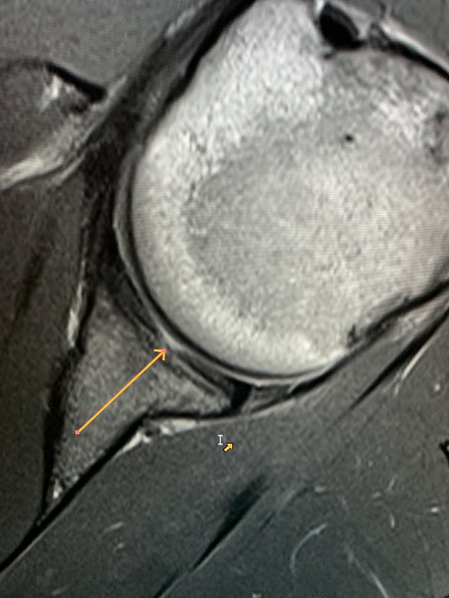 northwoods1980's tweet photo. Young patient. Normal glenoid central “bare spot”. https://t.co/nOXAK0qmZ1 https://t.co/qIIVvlsytI