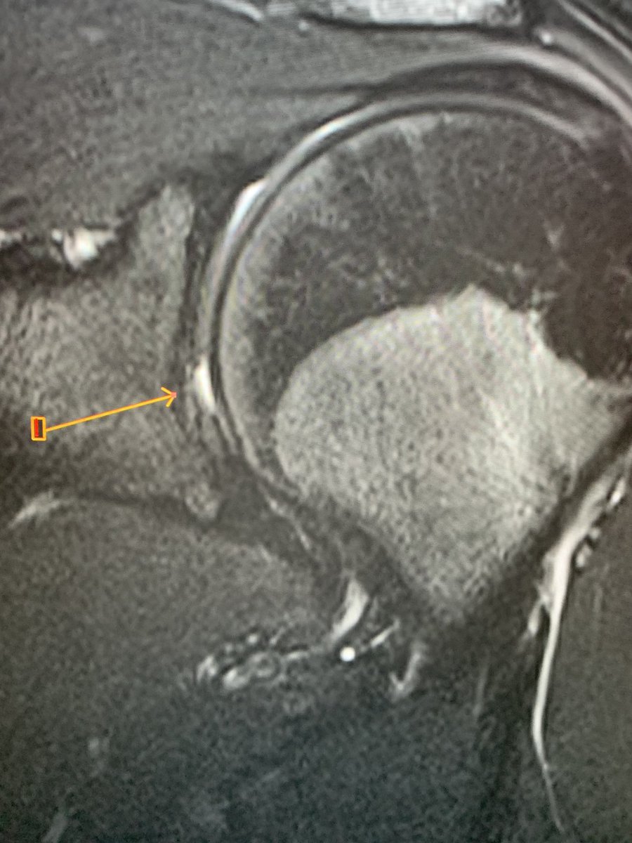 northwoods1980's tweet photo. Young patient. Normal glenoid central “bare spot”. https://t.co/nOXAK0qmZ1 https://t.co/qIIVvlsytI
