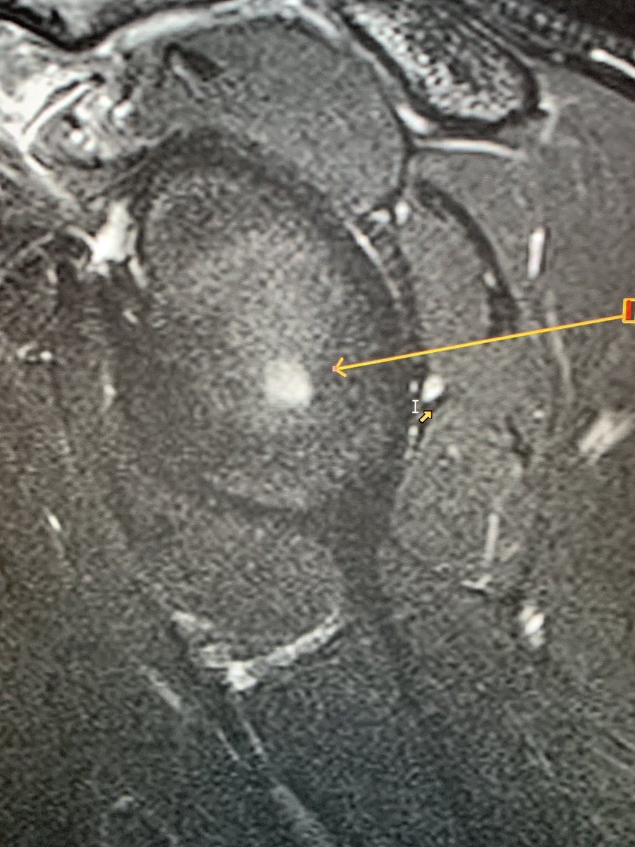 northwoods1980's tweet photo. Young patient. Normal glenoid central “bare spot”. https://t.co/nOXAK0qmZ1 https://t.co/qIIVvlsytI