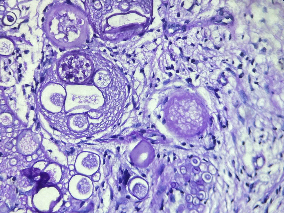 pathologicrain's tweet photo. @smlungpathguy Got the GMS and PASD today https://t.co/ddQoiidGYT