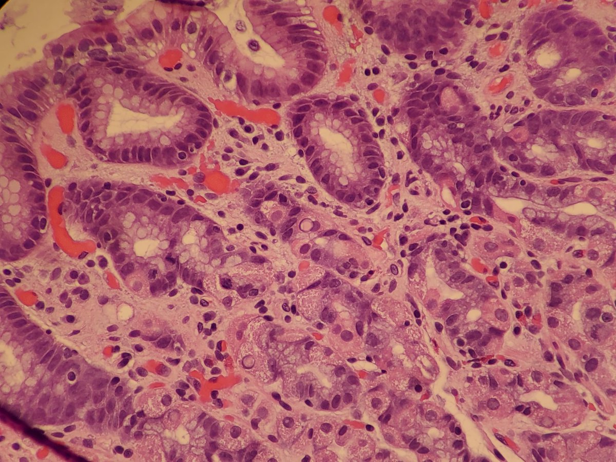 JacobRitter2's tweet photo. Does anyone know what these parietal cell nuclear inclusions are? Maybe some sort of medication effect? #PathTwitter #GIpath #pathology https://t.co/0FtwZ3ZfRK
