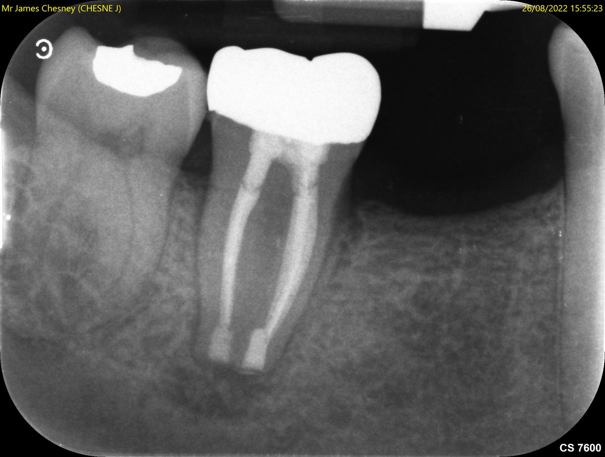 Great signs of early osseous healing @ 3months following intentional replantation LR7. 🤣 All sign and symptom free.