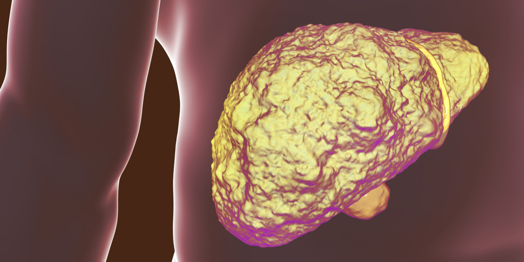 MDedge Hematology & Oncology (@mdedgehemonc) on Twitter photo People exposed to high levels of PFOS – a widely used synthetic chemical – run an increased risk of #HCC, researchers say. ms.spr.ly/6019jdtB7 People exposed to high levels of PFOS – a widely used synthetic chemical – run an increased risk of #HCC, researchers say. ms.spr.ly/6019jdtB7