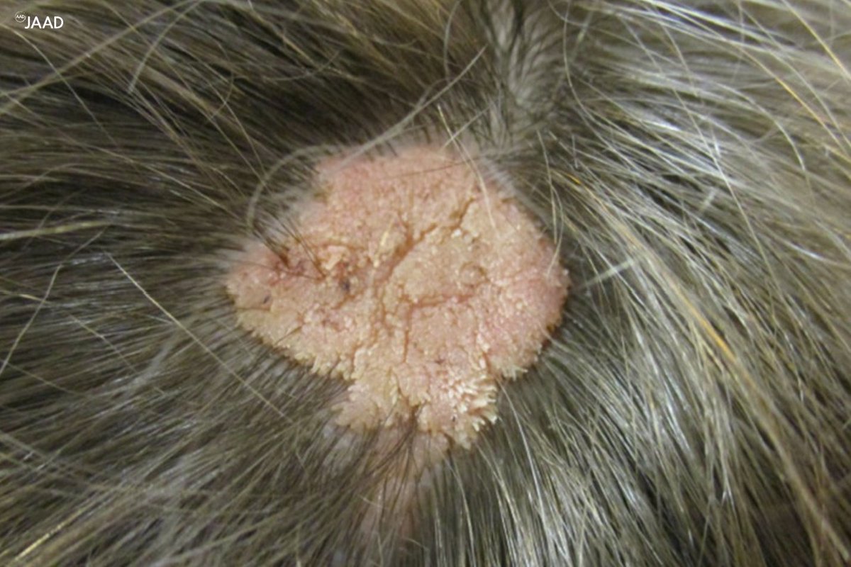 JAADjournals's tweet photo. Topical sirolimus therapy for nevus sebaceus and epidermal nevus: A case series https://t.co/0tJr3kQyll https://t.co/m3dew532Ck