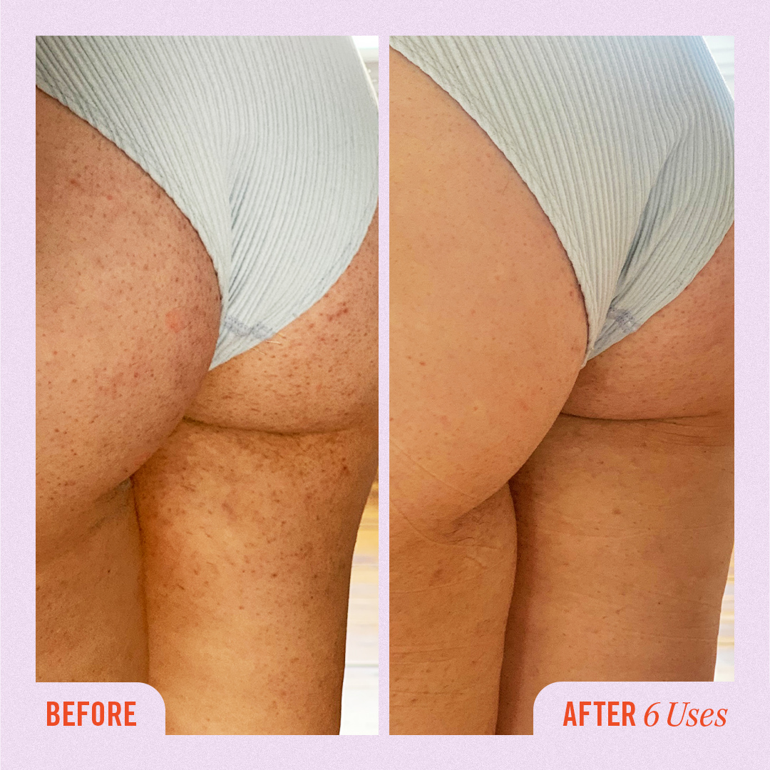 Say bye bye booty bumps with KP Bump Eraser Body Scrub 👋 

#buttne #keratosispilaris #strawberryskin #exfoliate #smoothskin