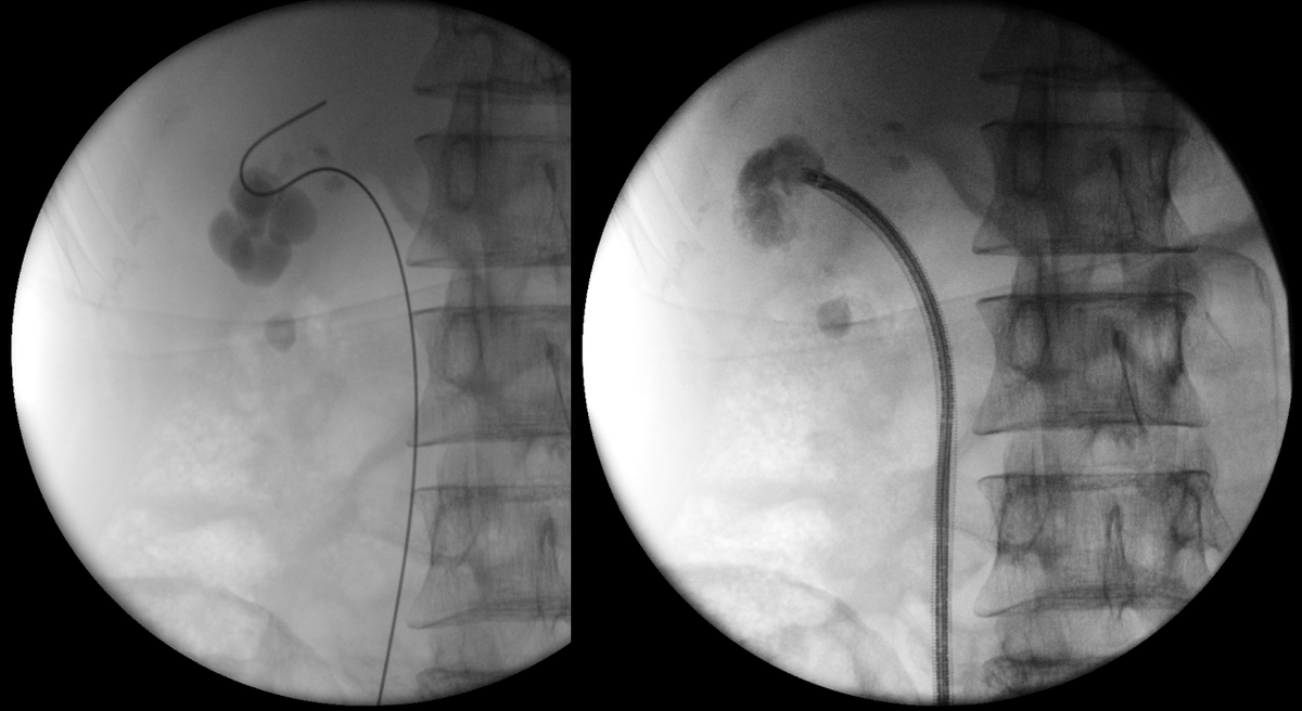 sbinhamrii's tweet photo. 🔄 Future Pilars of #MIS #Stone Treatment as Day Surgery:
◾️Bendable Ureteral Access Sheath 
◾️#TFL 
◾️+/- Suction or Venturi Effect 
@PETRAurogroup @OTRAXER @PEARLSendouro @DocGauhar https://t.co/i6e1srbSjT