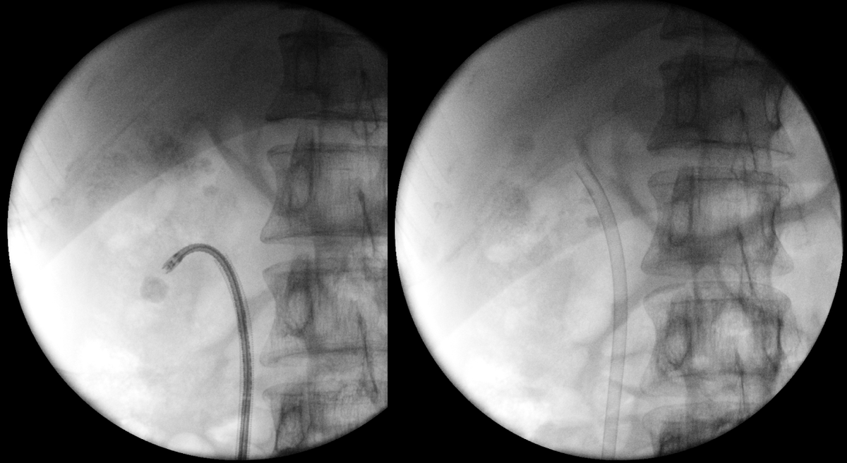 sbinhamrii's tweet photo. 🔄 Future Pilars of #MIS #Stone Treatment as Day Surgery:
◾️Bendable Ureteral Access Sheath 
◾️#TFL 
◾️+/- Suction or Venturi Effect 
@PETRAurogroup @OTRAXER @PEARLSendouro @DocGauhar https://t.co/i6e1srbSjT