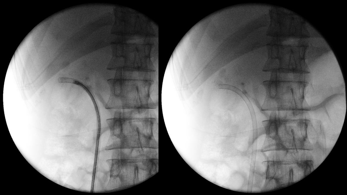 sbinhamrii's tweet photo. 🔄 Future Pilars of #MIS #Stone Treatment as Day Surgery:
◾️Bendable Ureteral Access Sheath 
◾️#TFL 
◾️+/- Suction or Venturi Effect 
@PETRAurogroup @OTRAXER @PEARLSendouro @DocGauhar https://t.co/i6e1srbSjT