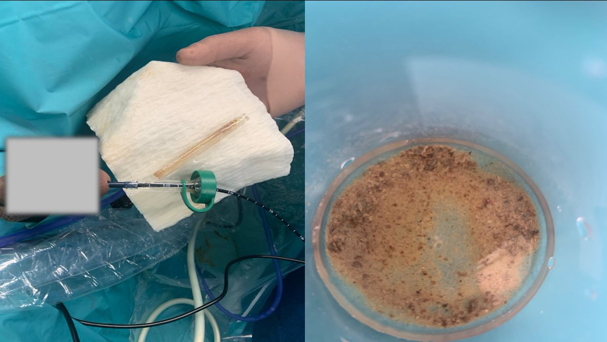 sbinhamrii's tweet photo. 🔄 Future Pilars of #MIS #Stone Treatment as Day Surgery:
◾️Bendable Ureteral Access Sheath 
◾️#TFL 
◾️+/- Suction or Venturi Effect 
@PETRAurogroup @OTRAXER @PEARLSendouro @DocGauhar https://t.co/i6e1srbSjT