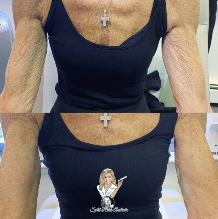 SplitRockAesIns's tweet photo. Want to tone and tighten flabby areas around your face and body❓

💫We offer many different modalities to improve skin texture and tone. Come see our body procedures we have including #secretrf #hyperdiluteradiesse #sculptra #exilisultra #profoundrf &amp; #pdothreads to name a few. https://t.co/7BvLtrqa1M