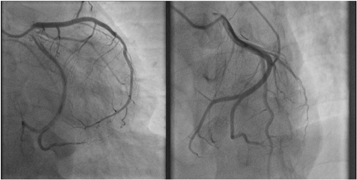 A new case published at #CJCOpen showing that Optical coherence tomography can be used to evaluate the mechanism of coronary injury following cardiac surgery, and guide management 👉 cjcopen.ca/article/S2589-… <a href="/arkugu21/">Arjun Gupta</a> <a href="/BElbarouni/">Basem Elbarouni</a> @UManitoba <a href="/Cardio_Girl/">Michelle Graham</a>