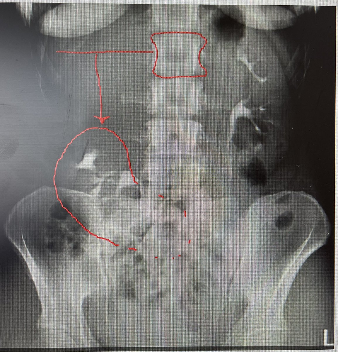 Daniel D Eun MD (@md_eun) on Twitter photo Nephroptosis is a rare & difficult dx to make. Most clinicians donโt really believe the problem is real & donโt do the workup. Pts end up frustrated @ are in tears by the time they find me. Here is a classic finding on IVP w/5cm descent. <a href="/TempleUrology/">Temple Urology</a> <a href="/Endo_Society/">Endourological Society</a> <a href="/SocietyGURS/">GURS</a> Nephroptosis is a rare & difficult dx to make. Most clinicians donโt really believe the problem is real & donโt do the workup. Pts end up frustrated @ are in tears by the time they find me. Here is a classic finding on IVP w/5cm descent. <a href="/TempleUrology/">Temple Urology</a> <a href="/Endo_Society/">Endourological Society</a> <a href="/SocietyGURS/">GURS</a>