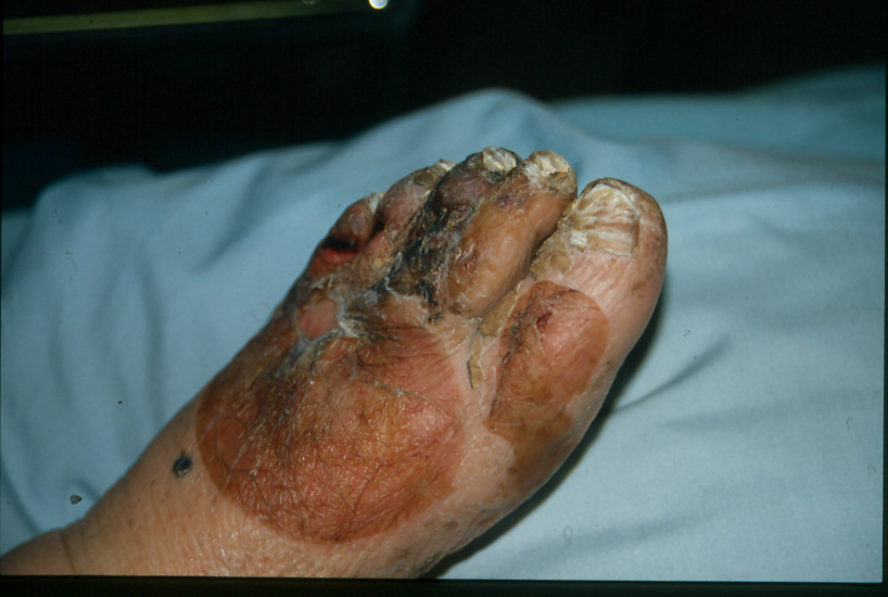 #Newsnight  here is one effect of fuel poverty . frostbite on a pensioner i saw in the 1980's. running one bar electic fire in mid winter