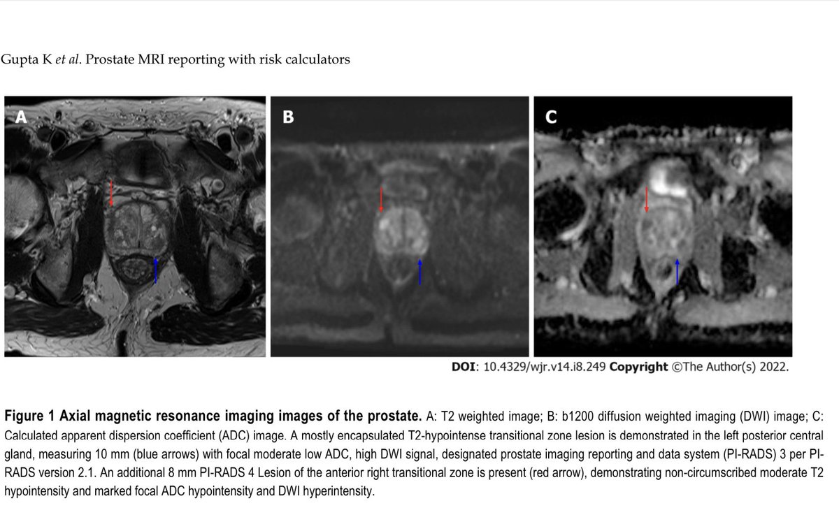 RaisBahrami's tweet photo. Proud of our team @KarismaGuptaDR @jordanperchik @afang5604 @KPorterUAB taking the next steps in prostate MRI reporting by integrating data from risk calculators to guide diagnostic recs. https://t.co/odZevihBx5 https://t.co/ldtaJcUncY