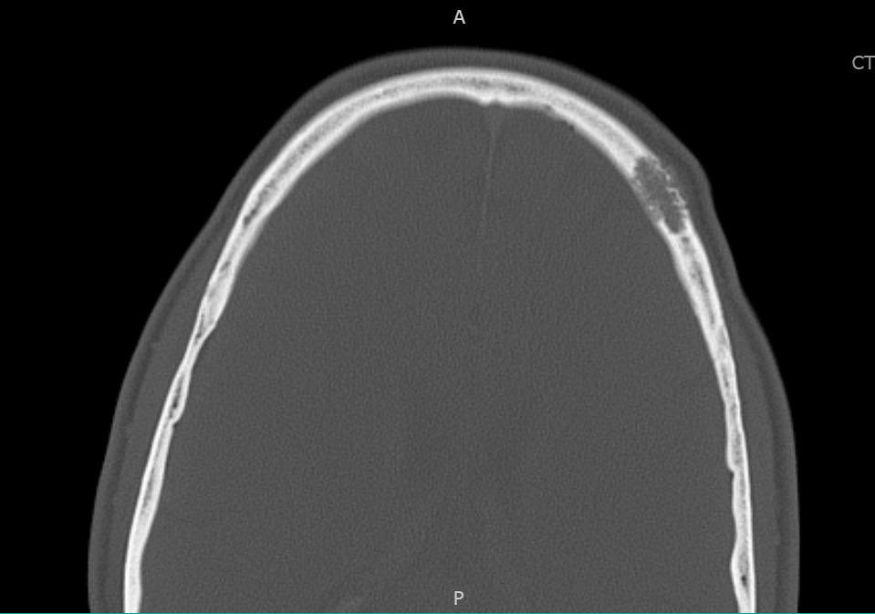Radiolucency in frontal bone 

sagittal + axial CT. 

Here’s a clue: Keep a low power impression

Mild expansive remodeling, cortical thinning, radial (spoke) trabecular bone radiating around a central lucency

Diagnosis? 

<a href="/reith16/">John Reith</a> <a href="/ahlawat_shivani/">Shivani Ahlawat</a> <a href="/LauraMFayad/">Laura Fayad</a> <a href="/LisaRooperMD/">Lisa Rooper</a>