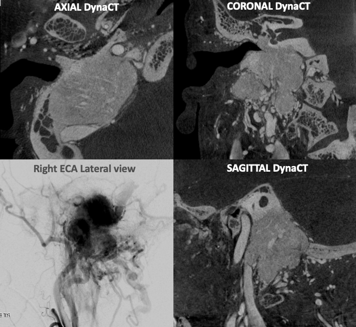 eytanraz's tweet photo. #dynaCT or #CBCTAngiography is very useful in multiple conditions including skull base tumor angiography. Here showing in supreme details the boundaries of the glomus jugulotympanicum, its invasion of the sigmoid sinus๐จ, the extension to middle ear๐ฆetc. https://t.co/RRQ5RF4xO7