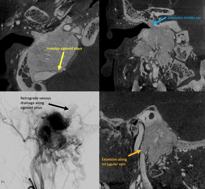 eytanraz's tweet photo. #dynaCT or #CBCTAngiography is very useful in multiple conditions including skull base tumor angiography. Here showing in supreme details the boundaries of the glomus jugulotympanicum, its invasion of the sigmoid sinus๐จ, the extension to middle ear๐ฆetc. https://t.co/RRQ5RF4xO7