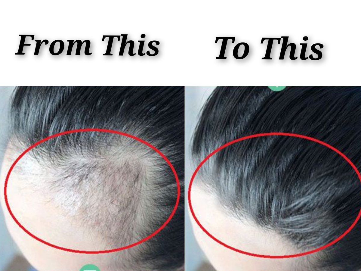 somexthings's tweet photo. Treatment untuk rambut rontok dan ketombe!

- a thread - https://t.co/mcvtyLcBT6