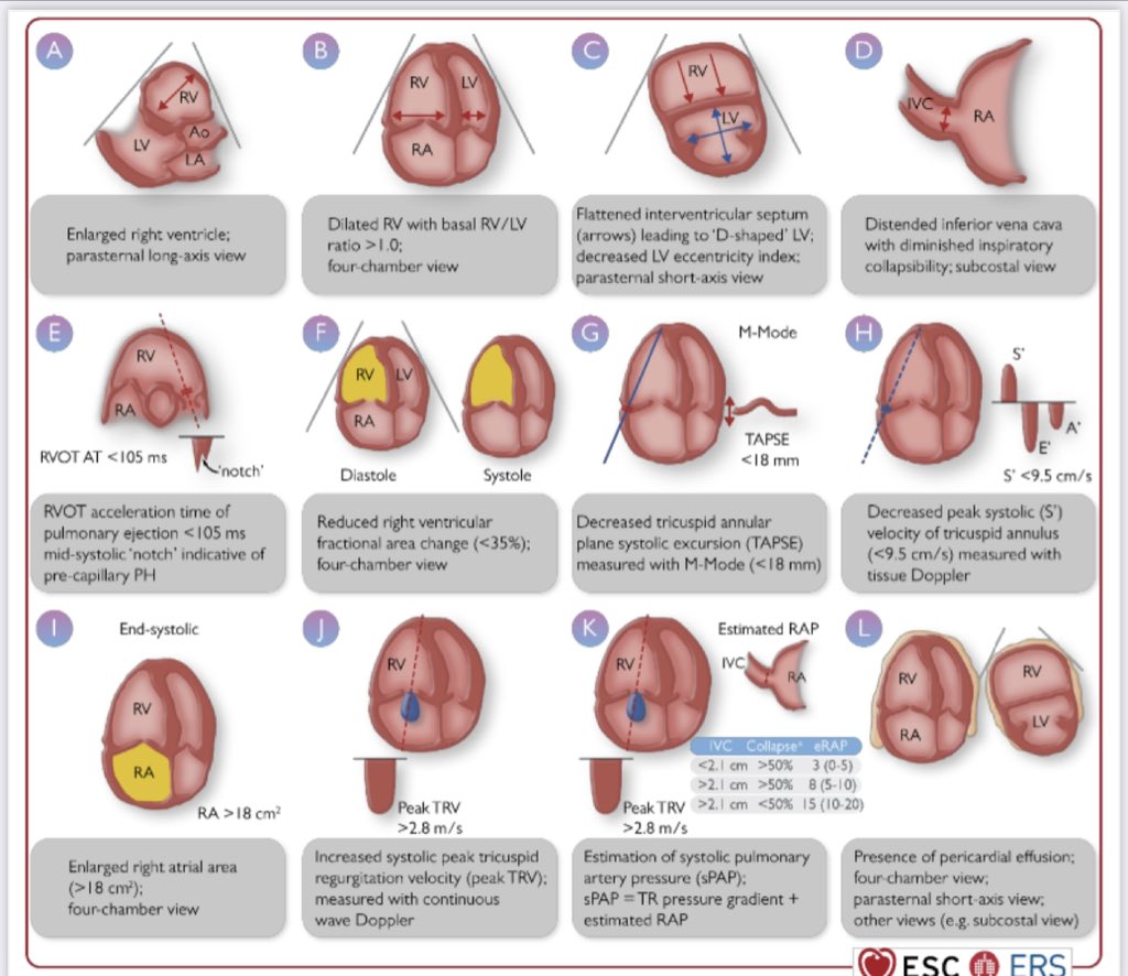 Innov_Medicine's tweet photo. #PHguidelines #esc2022 Finally! #RVfunction / RV-PA coupling is included is in the ESC guidelines! TAPSE/sPAP @escardio #EchoRight #echofirst @CardioOnline
h/t @MOCERIPamela1 https://t.co/rGRoyGhm1W