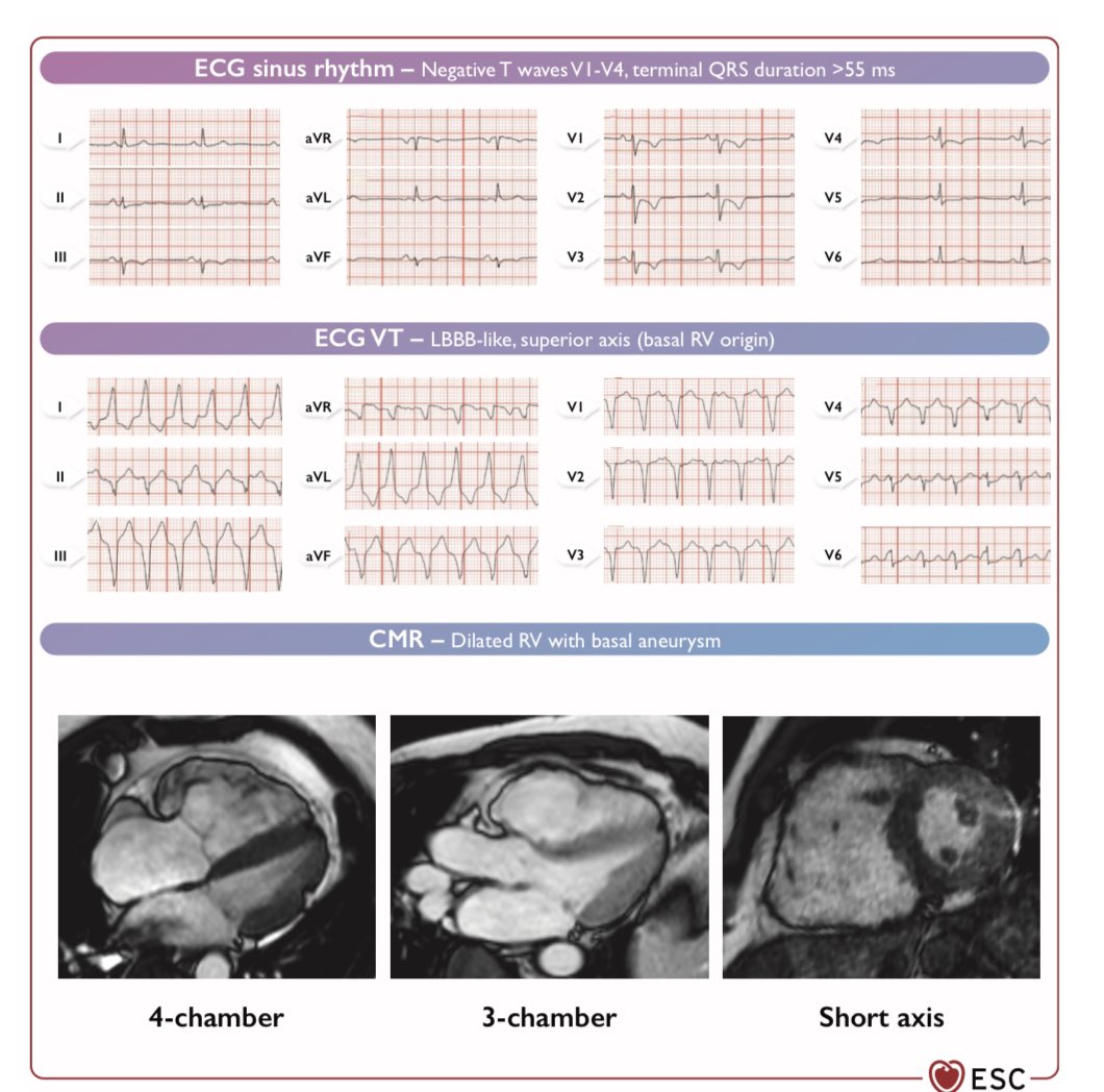 Excelente la nueva guía de arritmias ventriculares. Habría que ir pensando en repetir algunos de los estudios pivotales que se realizaron con DAIs pero utilizando los fármacos y tratamientos actuales. academic.oup.com/eurheartj/adva…