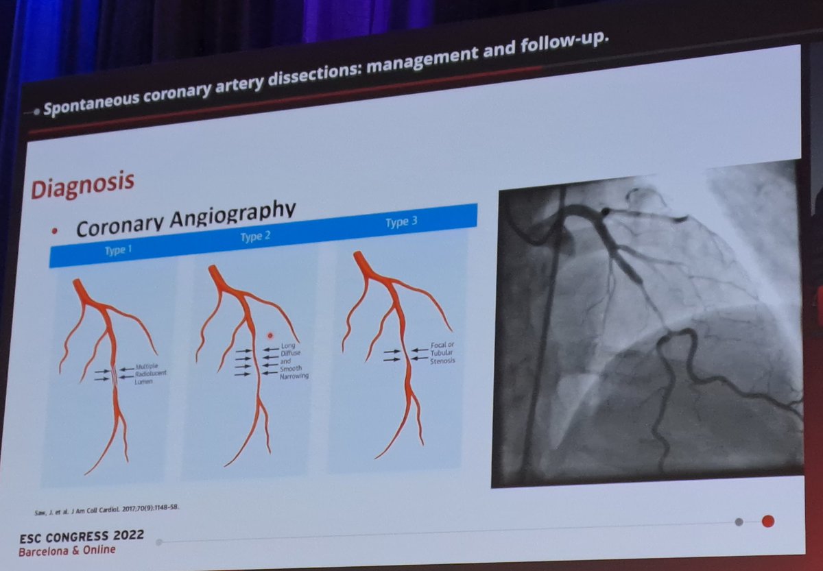 Coronary artery  dissection what to know / outside in... the problem starts in microvasculature says Andreas Baumbach #ESCCongress <a href="/escardio/">European Society of Cardiology</a> #cvAcute #acvc_esc <a href="/ACVCPresident/">ACVCPresident</a>  <a href="/umityasarsinan1/">Ümit Yaşar Sinan, MD, FESC</a> <a href="/drmilicaa/">Milica Aleksic</a> @susannaprice <a href="/mirvatalasnag/">MIЯVΛƬ #IC</a> <a href="/VijayKunadian/">Professor Vijay Kunadian</a>