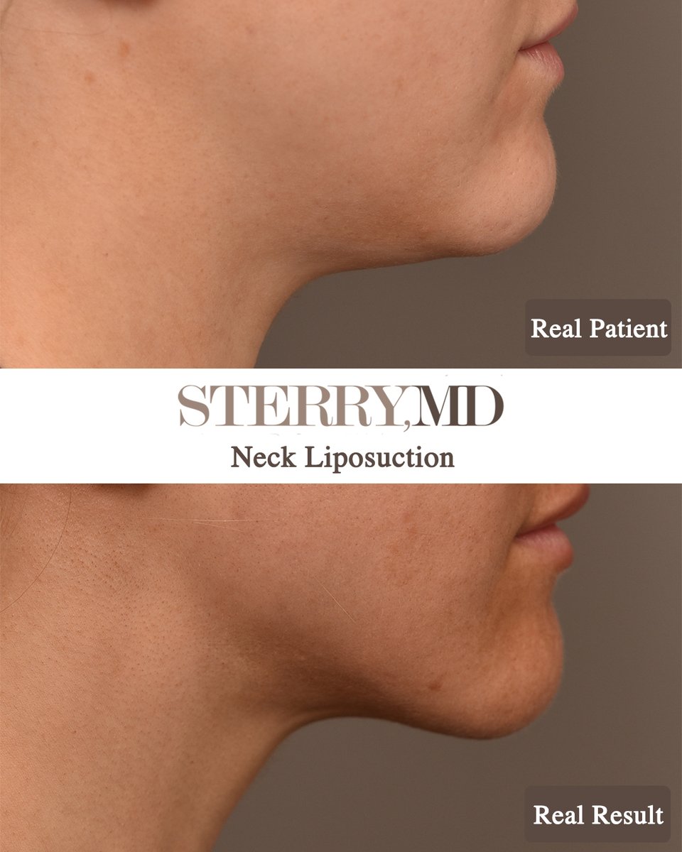 Another beautiful, natural-looking results!

Chin Liposuction can effectively eliminate a double chin and help tighten and sculpt the neckline to reveal beautiful definition in the jawline.

#chinlipo #beforeanafterliposuction #doublechinreduction #doublechinremoval