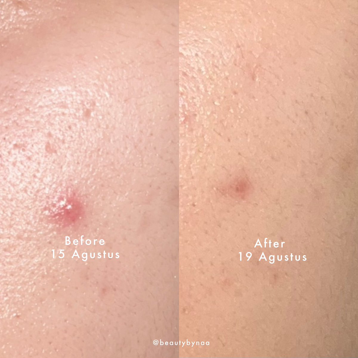 beautybynaa's tweet photo. Rekomendasi obat totol jerawat yang menurut aku ampuh buat jerawat cepet kempes🥹✨
ㅡ a thread
#letsbeeclear https://t.co/e9wqi16x1F