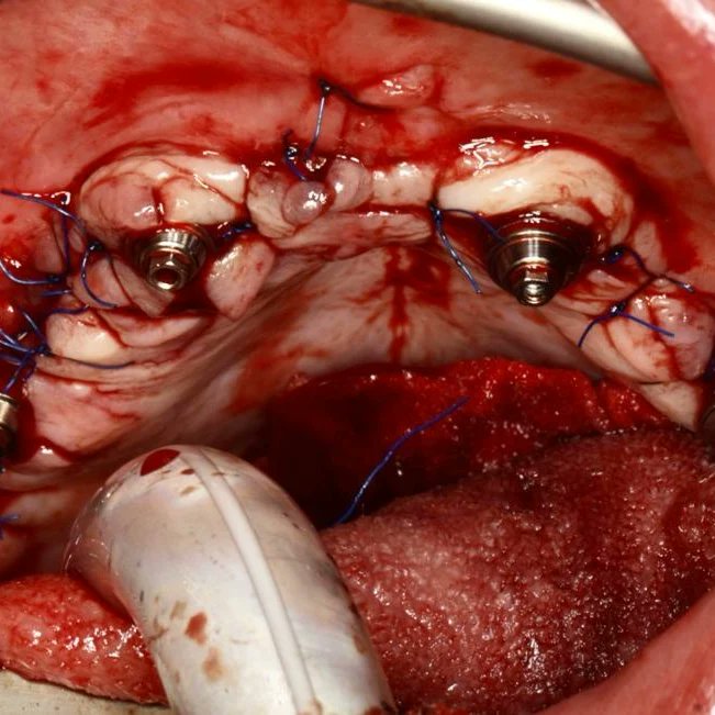 boneeasy's tweet photo. FAQ.
How do I rehabilitate Implantize Compact?
Emerging from the gum you will see standard Multiunits abutments that are compatible with the majority os dental implant systems, so you just have to use your regular prosthetic protocols
#implantizecompact
#dentalimplants https://t.co/gyTKOQtXrj