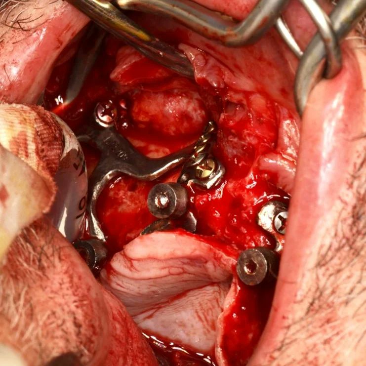 boneeasy's tweet photo. FAQ.
How do I rehabilitate Implantize Compact?
Emerging from the gum you will see standard Multiunits abutments that are compatible with the majority os dental implant systems, so you just have to use your regular prosthetic protocols
#implantizecompact
#dentalimplants https://t.co/gyTKOQtXrj
