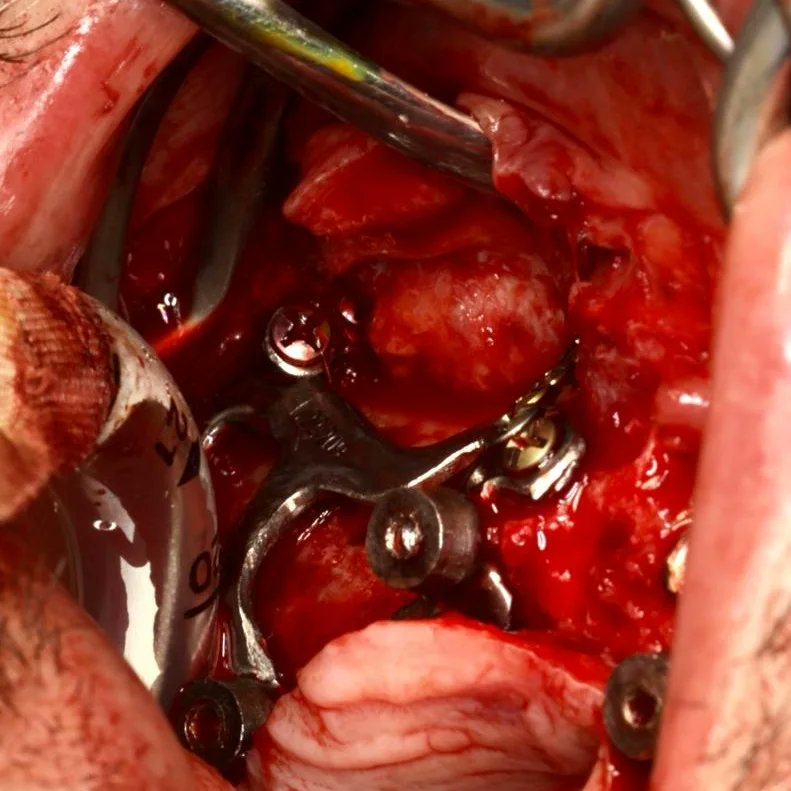 boneeasy's tweet photo. FAQ.
How do I rehabilitate Implantize Compact?
Emerging from the gum you will see standard Multiunits abutments that are compatible with the majority os dental implant systems, so you just have to use your regular prosthetic protocols
#implantizecompact
#dentalimplants https://t.co/gyTKOQtXrj